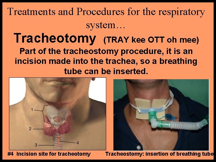 Treatments and Procedures for the respiratory system… Tracheotomy (TRAY kee OTT oh mee) Part