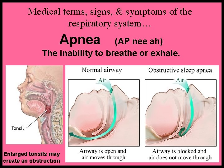 Medical terms, signs, & symptoms of the respiratory system… Apnea (AP nee ah) The