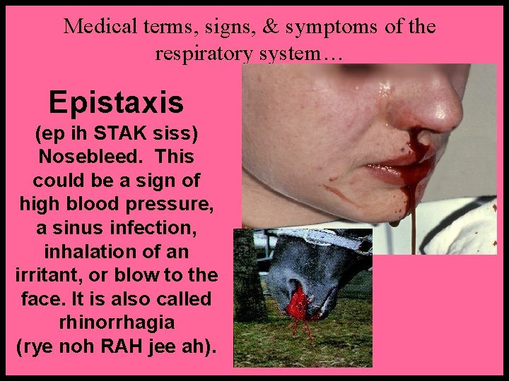 Medical terms, signs, & symptoms of the respiratory system… Epistaxis (ep ih STAK siss)