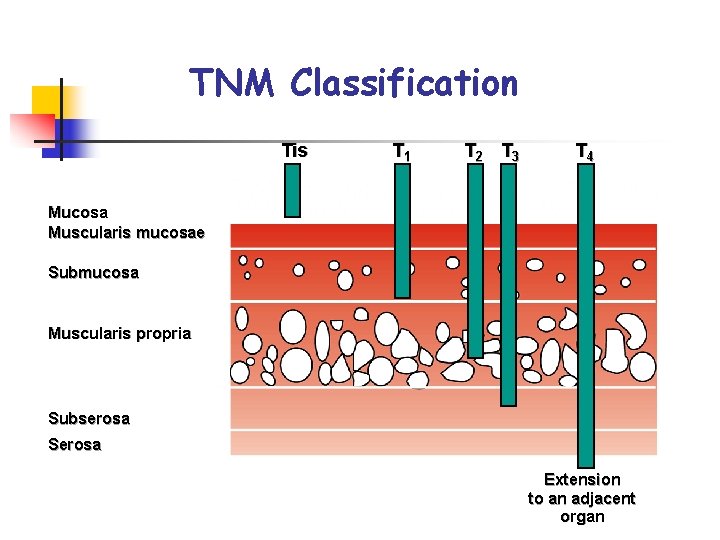 TNM Classification Tis T 1 T 2 T 3 T 4 Mucosa Muscularis mucosae