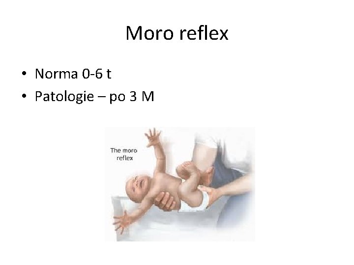 Moro reflex • Norma 0 -6 t • Patologie – po 3 M 