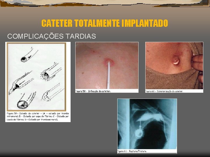 CATETER TOTALMENTE IMPLANTADO COMPLICAÇÕES TARDIAS 