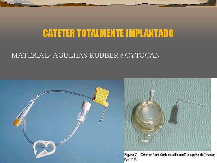 CATETER TOTALMENTE IMPLANTADO MATERIAL- AGULHAS RUBBER e CYTOCAN 
