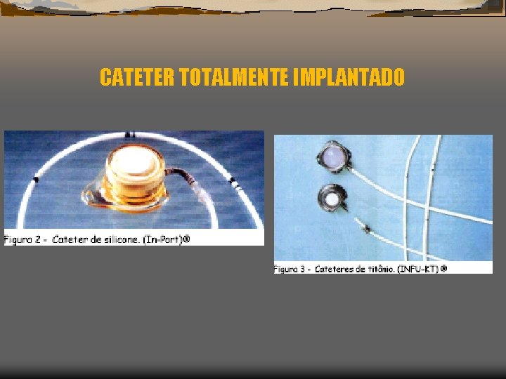 CATETER TOTALMENTE IMPLANTADO 