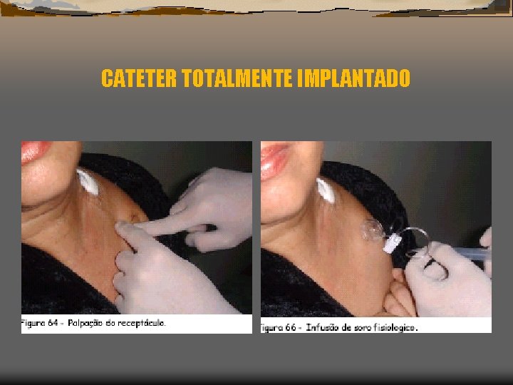 CATETER TOTALMENTE IMPLANTADO 