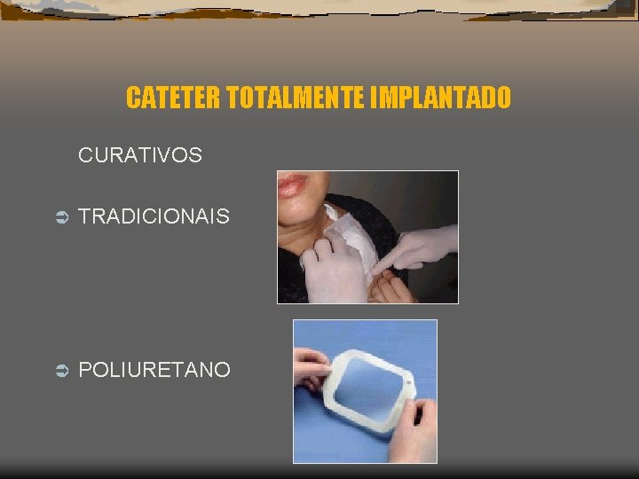 CATETER TOTALMENTE IMPLANTADO CURATIVOS Ü TRADICIONAIS Ü POLIURETANO 