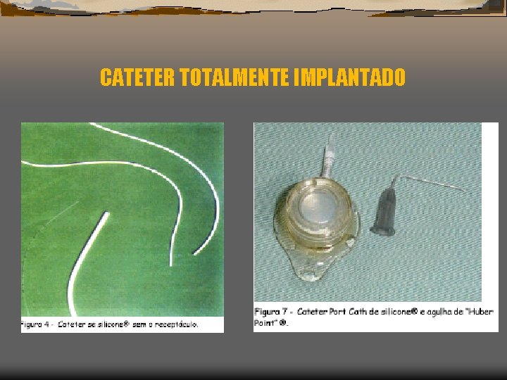 CATETER TOTALMENTE IMPLANTADO 