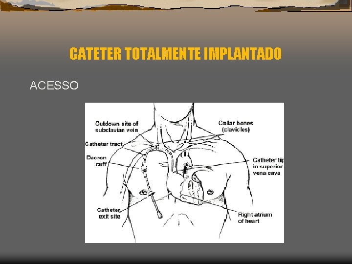 CATETER TOTALMENTE IMPLANTADO ACESSO 