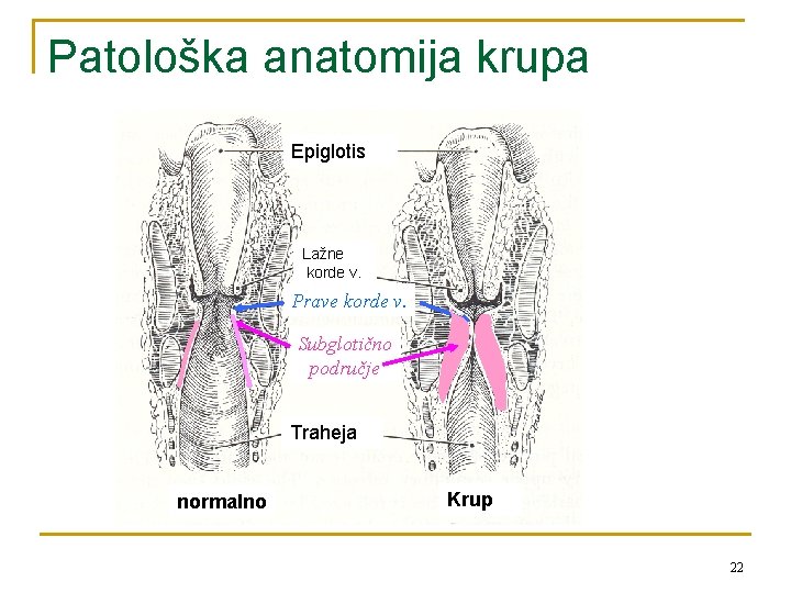 Patološka anatomija krupa Epiglotis Lažne korde v. Prave korde v. Subglotično područje Traheja normalno