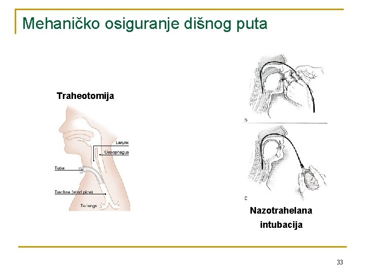 Mehaničko osiguranje dišnog puta Traheotomija Nazotrahelana intubacija 33 