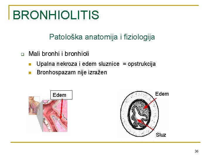 BRONHIOLITIS Patološka anatomija i fiziologija q Mali bronhioli n n Upalna nekroza i edem