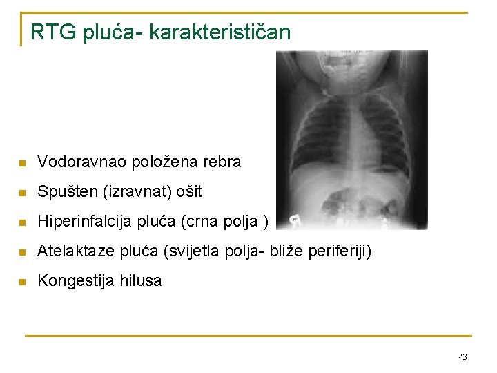 RTG pluća- karakterističan n Vodoravnao položena rebra n Spušten (izravnat) ošit n Hiperinfalcija pluća