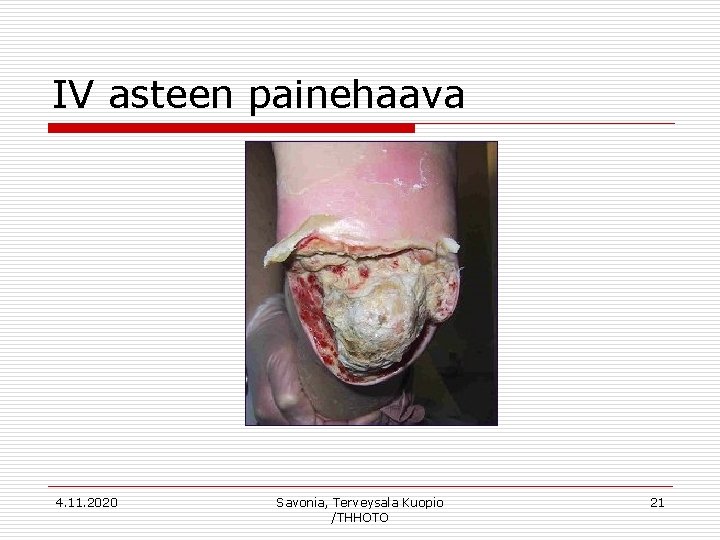 IV asteen painehaava 4. 11. 2020 Savonia, Terveysala Kuopio /THHOTO 21 