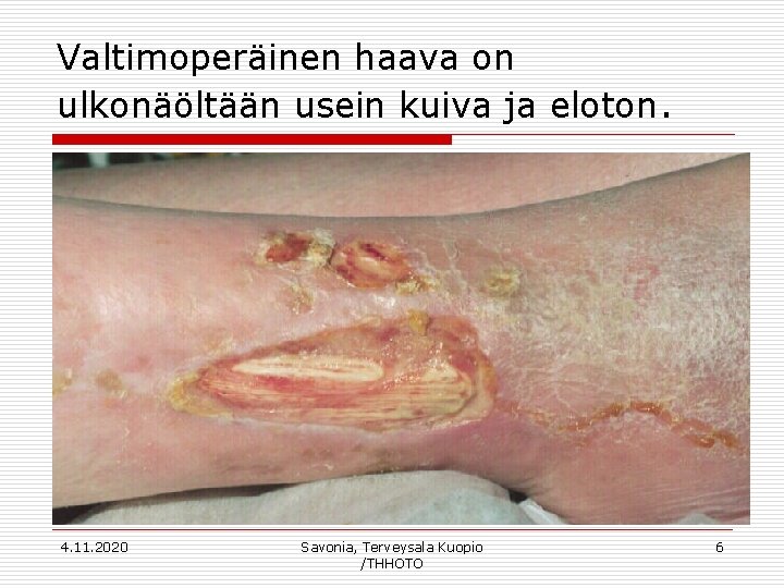 Valtimoperäinen haava on ulkonäöltään usein kuiva ja eloton. 4. 11. 2020 Savonia, Terveysala Kuopio