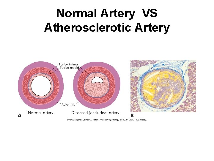 Normal Artery VS Atherosclerotic Artery 