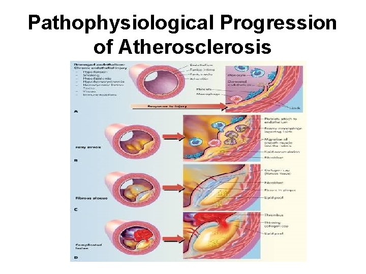 Pathophysiological Progression of Atherosclerosis 