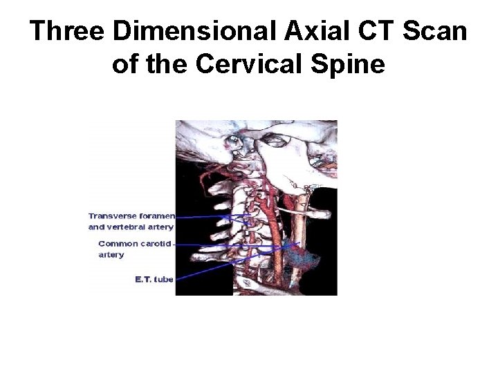 Three Dimensional Axial CT Scan of the Cervical Spine 