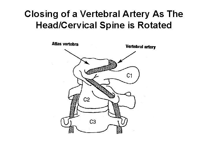Closing of a Vertebral Artery As The Head/Cervical Spine is Rotated 