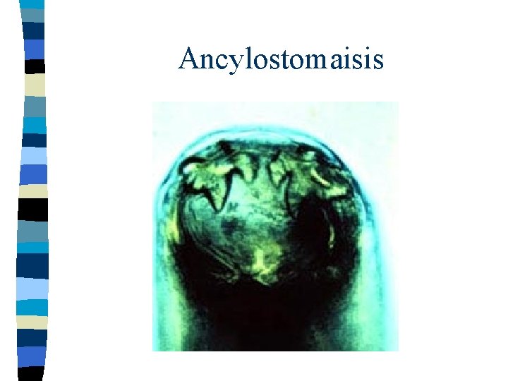 Ancylostomaisis 