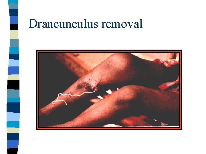 Drancunculus removal 