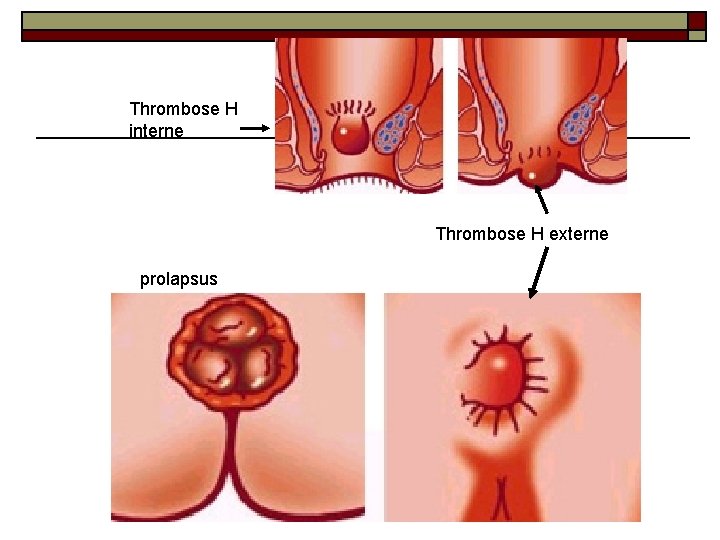 Thrombose H interne Thrombose H externe prolapsus 