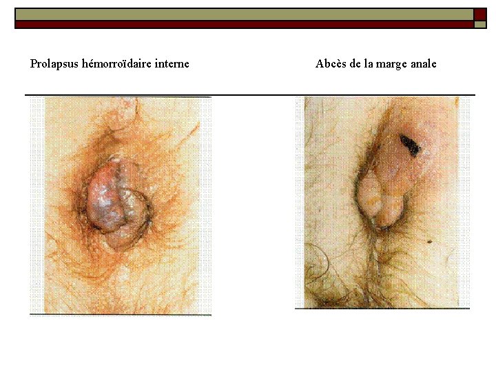 Prolapsus hémorroïdaire interne Abcès de la marge anale 