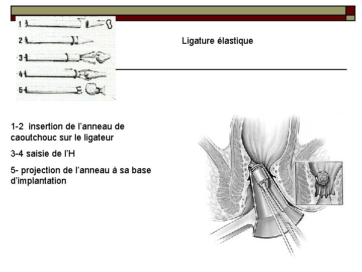 Ligature élastique 1 -2 insertion de l’anneau de caoutchouc sur le ligateur 3 -4