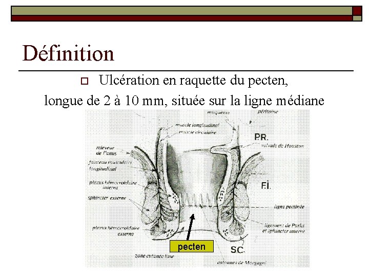Définition Ulcération en raquette du pecten, longue de 2 à 10 mm, située sur