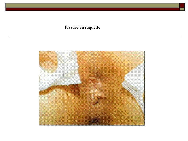 Fissure en raquette 