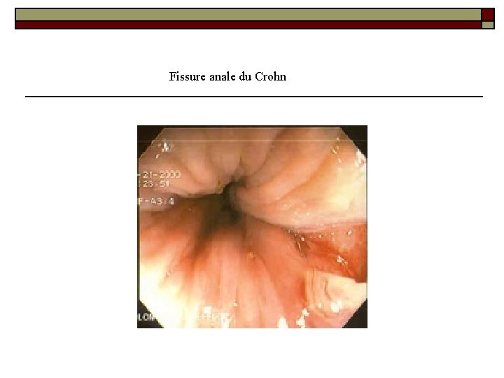 Fissure anale du Crohn 