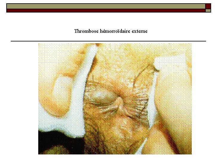 Thrombose hémorroïdaire externe 