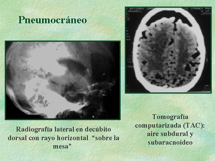 Pneumocráneo Radiografía lateral en decúbito dorsal con rayo horizontal “sobre la mesa” Tomografía computarizada
