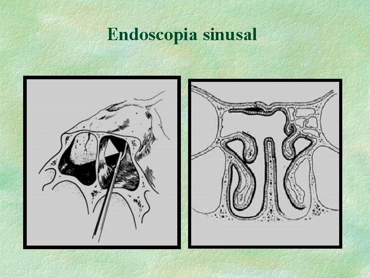 Endoscopia sinusal 