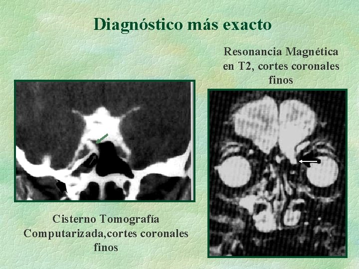 Diagnóstico más exacto Resonancia Magnética en T 2, cortes coronales finos Cisterno Tomografía Computarizada,