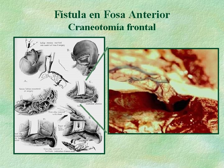 Fístula en Fosa Anterior Craneotomía frontal 