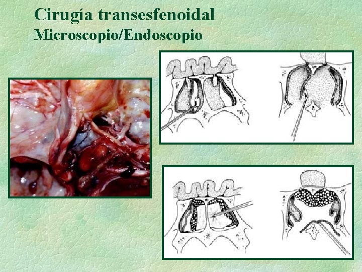 Cirugía transesfenoidal Microscopio/Endoscopio 