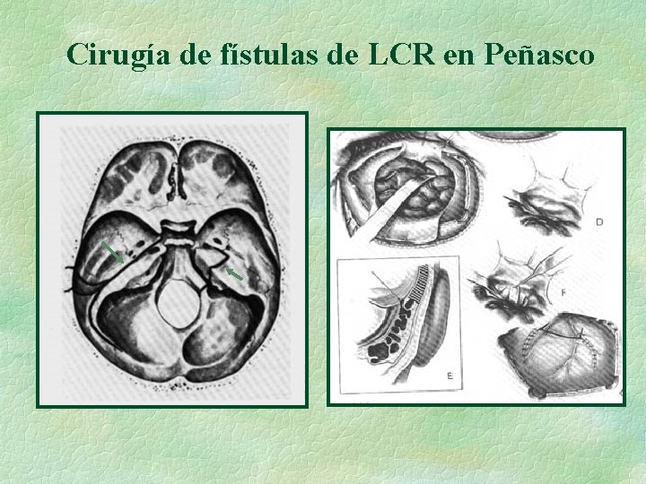 Cirugía de fístulas de LCR en Peñasco 
