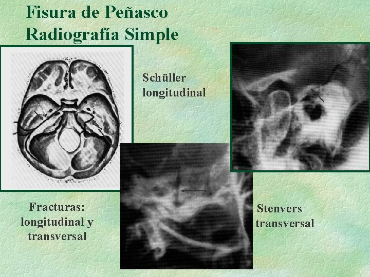 Fisura de Peñasco Radiografía Simple Schüller longitudinal Fracturas: longitudinal y transversal Stenvers transversal 