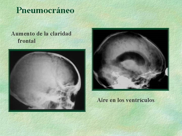 Pneumocráneo Aumento de la claridad frontal Aire en los ventrículos 