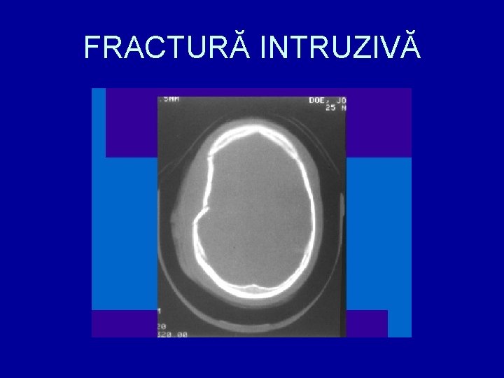 FRACTURĂ INTRUZIVĂ 