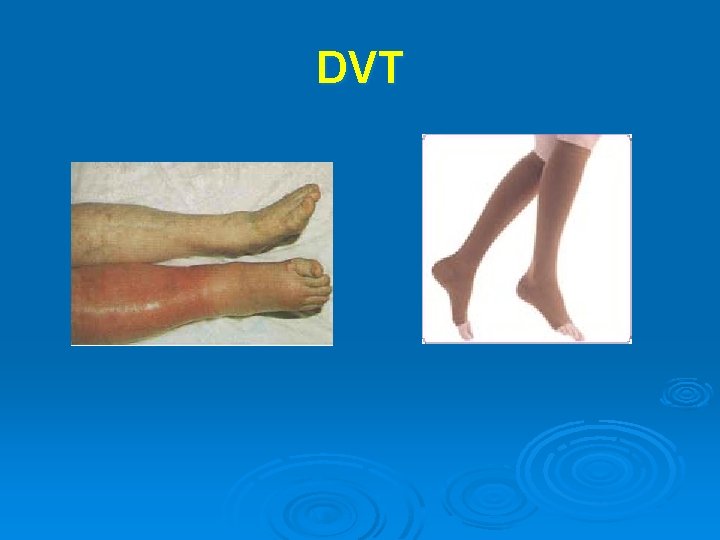 DVT 