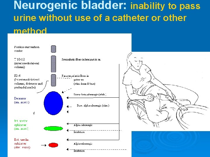 Neurogenic bladder: inability to pass urine without use of a catheter or other method