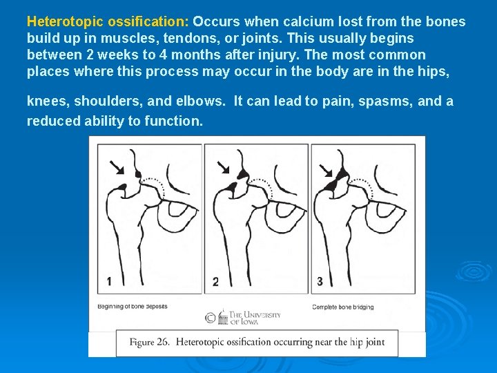 Heterotopic ossification: Occurs when calcium lost from the bones build up in muscles, tendons,