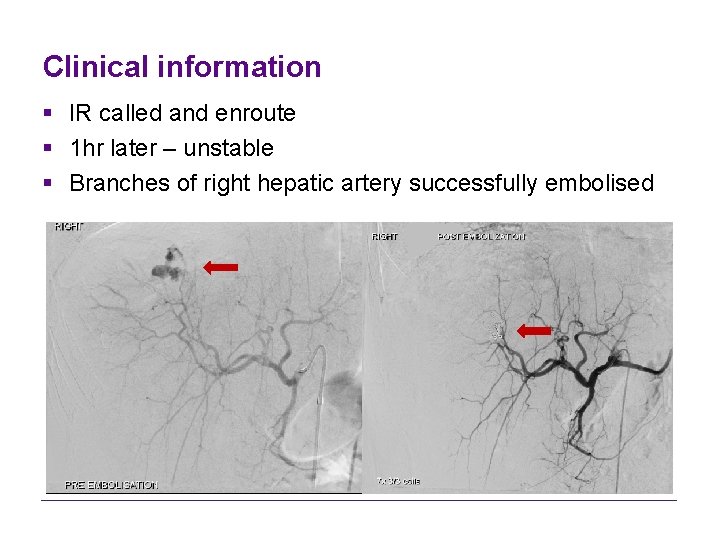 Clinical information § IR called and enroute § 1 hr later – unstable §