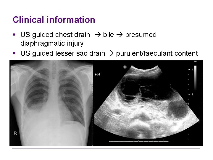 Clinical information § US guided chest drain bile presumed diaphragmatic injury § US guided