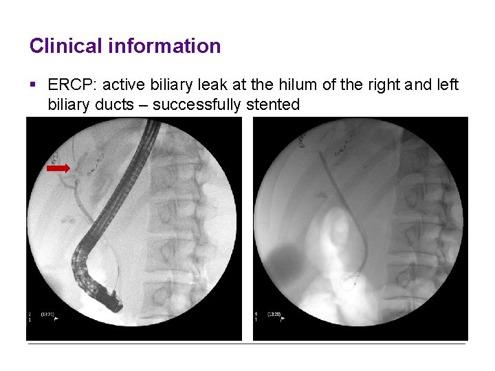 Clinical information § ERCP: active biliary leak at the hilum of the right and