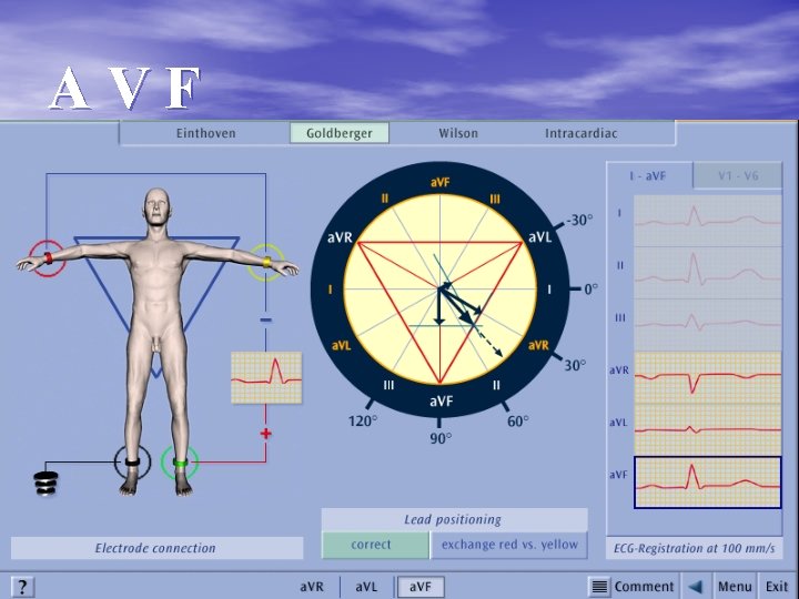 AVF 