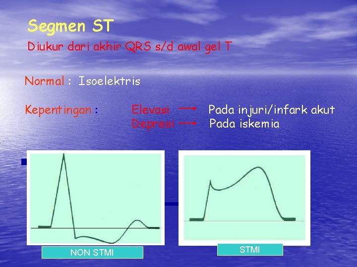 Segmen ST Diukur dari akhir QRS s/d awal gel T Normal : Isoelektris Kepentingan