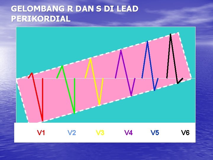 GELOMBANG R DAN S DI LEAD PERIKORDIAL V 1 V 2 V 3 V