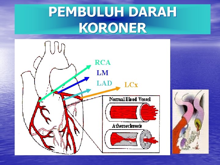 PEMBULUH DARAH KORONER RCA LM LAD LCx 